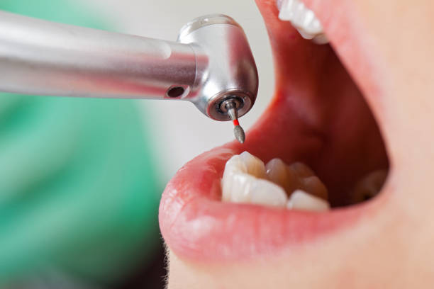 Best Broken or Chipped Tooth Repair in Ocklawaha, FL